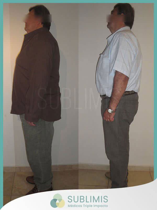 Tratamiento de la Diabetes - Cirugía Metabólica - Córdoba Tratamiento de la Diabetes - Cirugía Metabólica - Córdoba
