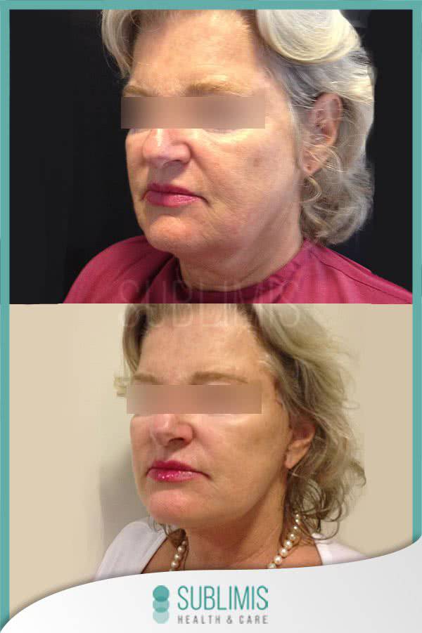 Lifting Facial Precio Cirugía Plástica Facial en Argentina
