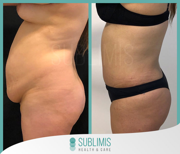 Tummy Tuck Abroad  Abdominoplasty Surgery in Argentina
