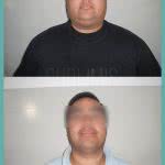 Antes y Después del Bypass Gastrico