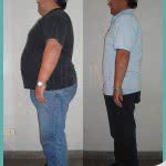 Antes y Despues de una Operacion de Bypass Gastrico