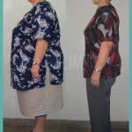 Bypass Gastrico Antes y Despues