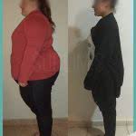 Bypass Gastrico Fotos Antes y Despues