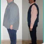 Bypass Gastrico en Hombres Fotos