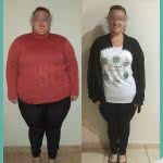 Bypass Gastrico Mujer Antes y Despues