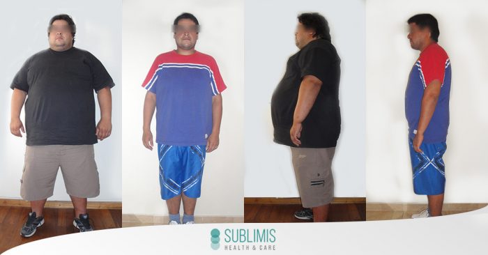 Antes y Después de un Bypass Gastrico