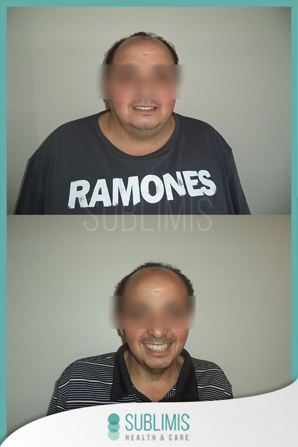 Antes y Despues de una Cirugia Bariatrica