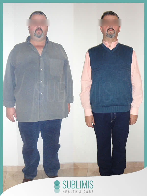 Bypass Gastrico en Hombres Antes y Despues