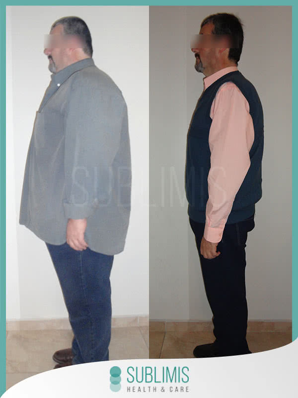 Bypass Gastrico en Hombres Fotos