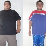 pre-post-bypass-gastrico